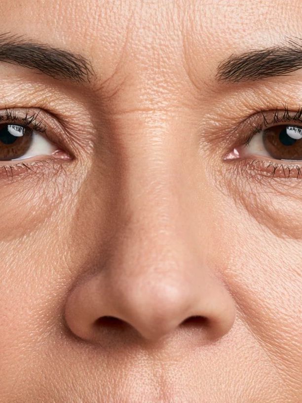 Eye Bags