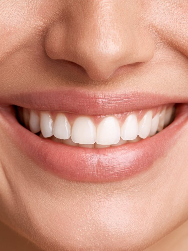Gummy Smile