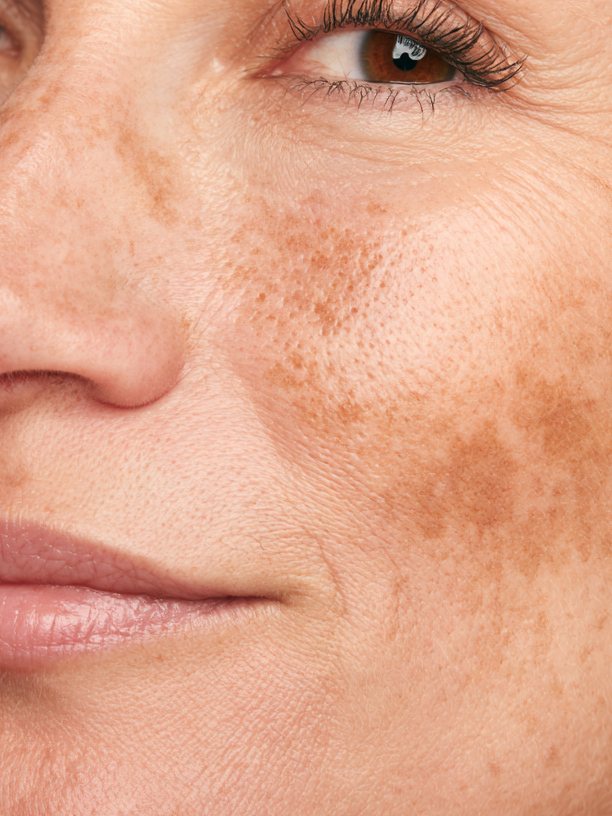 Melasma