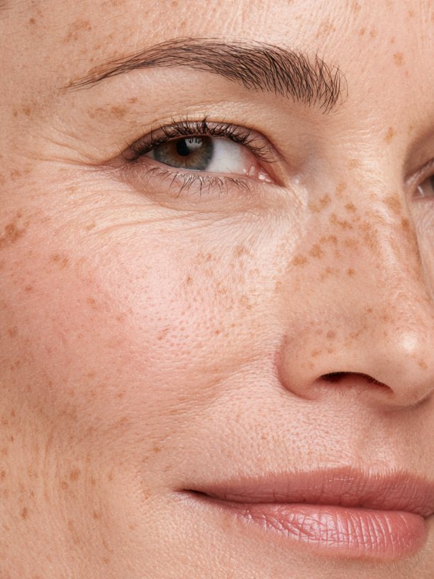 Pigmentation — uneven tonal patches with softly feathered edges