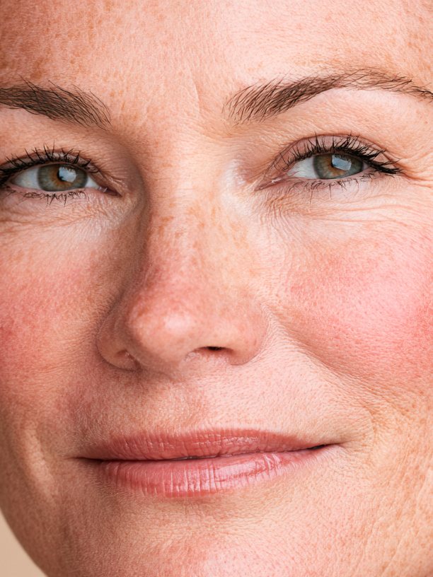 Skin Redness & Rosacea
