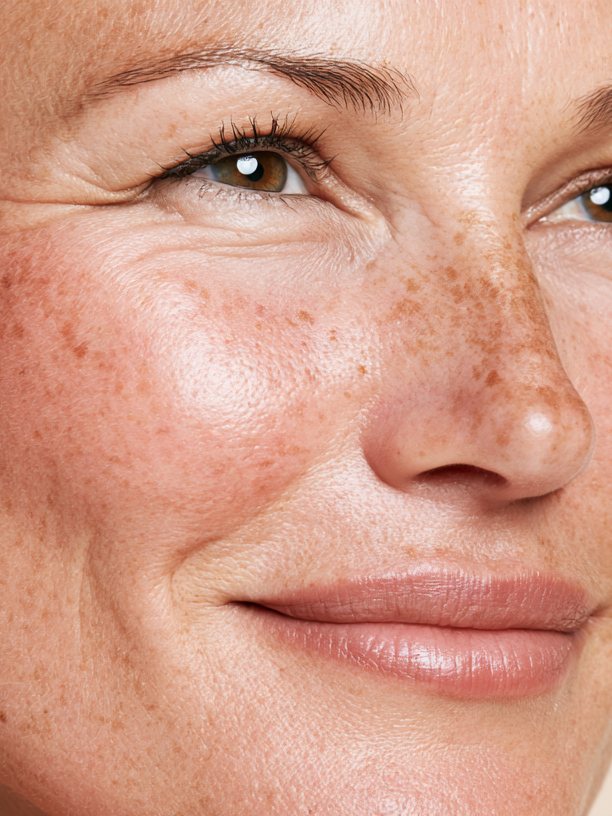 Sun Damage