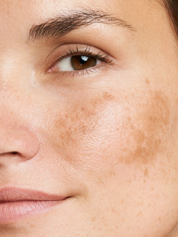 Uneven Skin Tone
