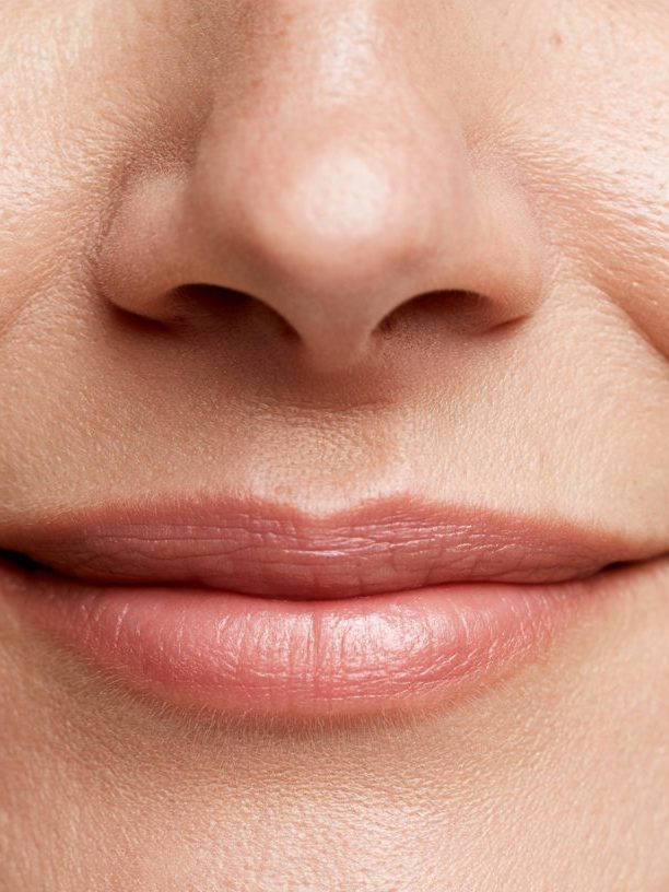 Nasolabial Filler